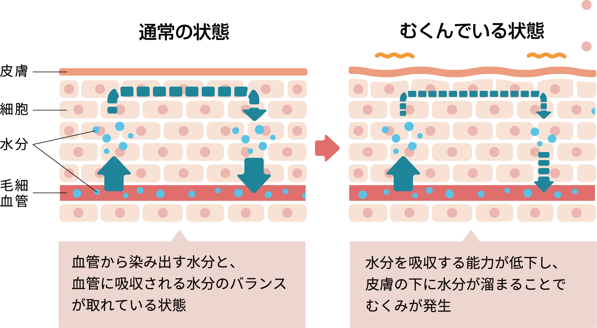 むくみってどうして起こるの？