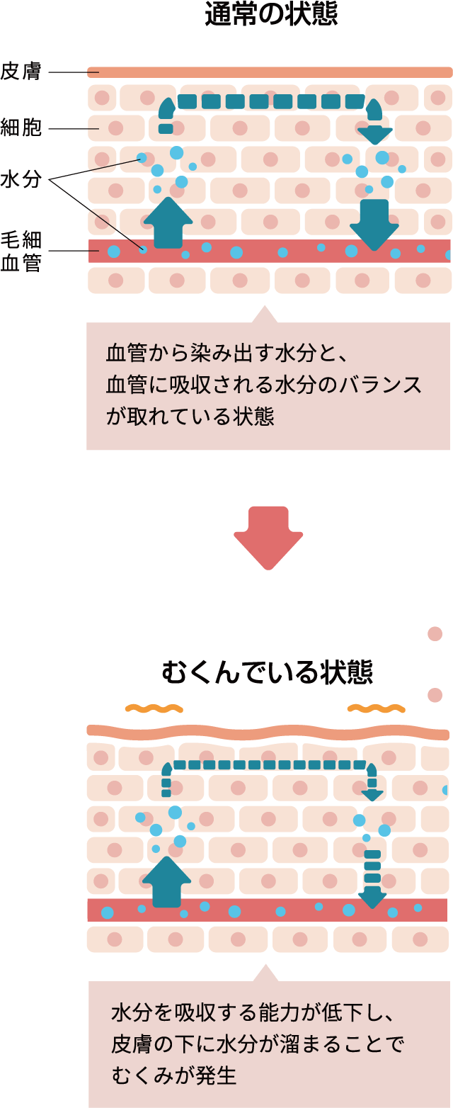 むくみってどうして起こるの？